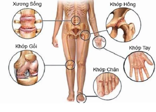 Cách ngừa đau khớp vào mùa mưa, lạnh