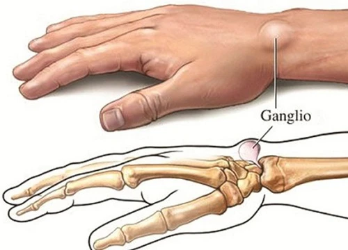 6 dấu hiệu cảnh báo sớm bệnh ung thư xương mà bạn không nên chủ quan bỏ qua