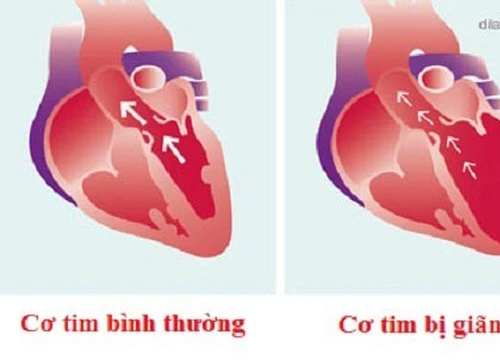 Căn bệnh nào được xem là &#8216;ung thư của tim&#8217;?