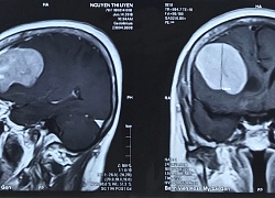 Phẫu thuật thành công khối u màng não khổng lồ cho cụ bà 76 tuổi