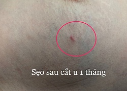 Hy vọng mới cho các chị em phải điều trị u xơ tuyến vú