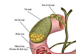 Phẫu thuật cho nữ bệnh nhân mang gần 300 viên sỏi mật