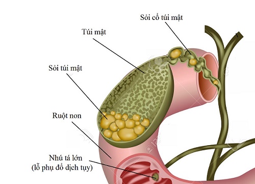 Phẫu thuật cho nữ bệnh nhân mang gần 300 viên sỏi mật