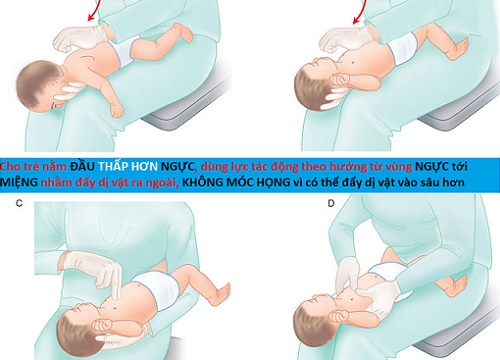 Bé 11 tháng tử vong tức tưởi do hóc món nhiều trẻ đều thích ăn