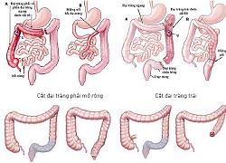 Giải thoát người ung thư trực tràng khỏi hậu môn nhân tạo