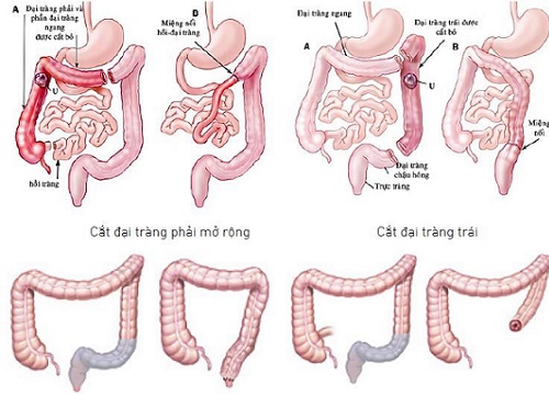 Giải thoát người ung thư trực tràng khỏi hậu môn nhân tạo