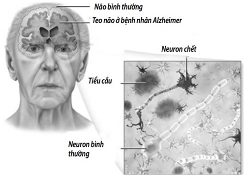 Sa sút trí tuệ: Phòng ngừa được không?