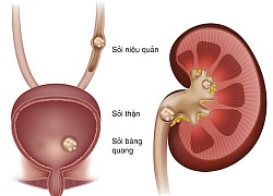 &#8216;Giải mã&#8217; các phương pháp trị sỏi thận