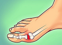 Sự thật: ngày càng nhiều người bị gout và đây là cách để hạn chế những cơn đau kinh khủng ấy