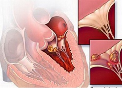 Virus siêu nhỏ nhưng gây viêm cơ tim cấp nguy hiểm