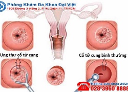 5 khuyến cáo có thể giúp bạn tránh ung thư tử cung