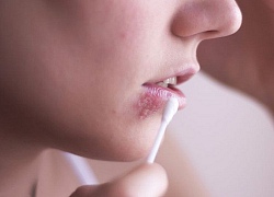 Nhận biết bệnh Herpes - mụn rộp sinh dục thông qua những triệu chứng cơ bản