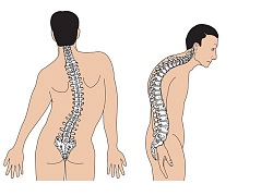 Vẹo cột sống mà... không biết