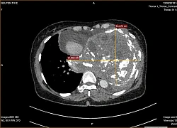 Khối u to như quả bóng đẩy tim bệnh nhân sang ngực phải