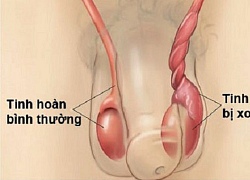 Bé trai 6 tuổi phải cắt bỏ tinh hoàn sau một đêm đau bụng