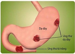 Chủ quan nghĩ đau bụng do viêm loét, đi khám thành ung thư dạ dày