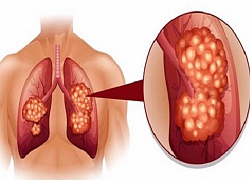 Ung thư phổi làm sao để phát hiện sớm?