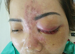 Vụ tiêm filler mù mắt: Cơ sở spa quảng cáo trên facebook để câu khách