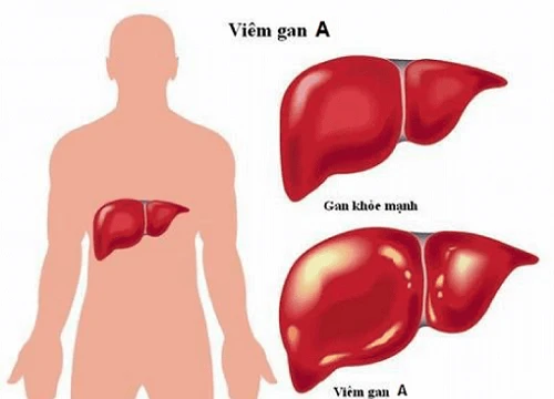 Bệnh viêm gan A là gì? Lây qua những đường nào?