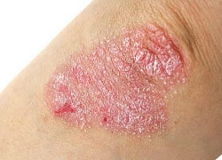 Nguyên nhân gây bệnh Eczema không phải ai cũng biết