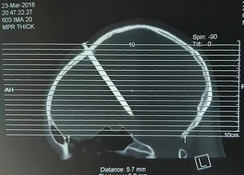 Phát hiện đinh dài gần 5 cm trong hộp sọ người đàn ông Trung Quốc