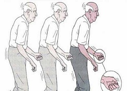 Cấy ghép thiết bị điện tử điều trị bệnh Parkinson