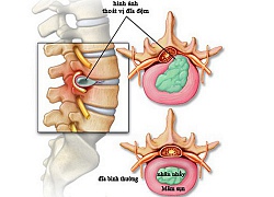 10 biểu hiện nhìn là biết ngay của thoát vị đĩa đệm