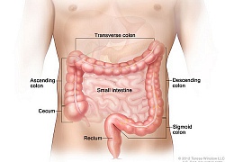 Cảnh báo ung thư đại trực tràng tăng báo động ở người trẻ vì thói quen này