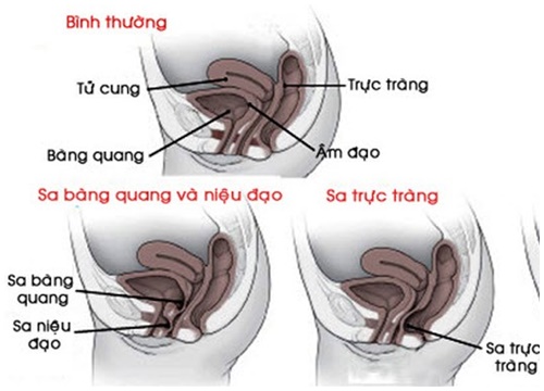 Sa tạng chậu: Nữ 20 tuổi chưa sinh nở vẫn bị