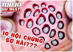 10 hội chứng sợ kỳ lạ nhất , đến tiền cũng làm người khác sợ