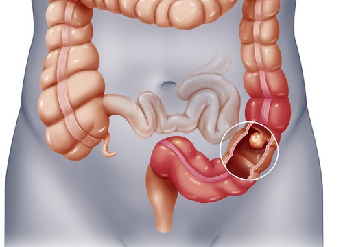 Người phụ nữ bị tắc ruột sau khi ăn 10 quả hồng, cảnh báo mọi người cẩn trọng khi ăn loại quả này