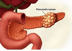 Những lưu ý quan trọng về bệnh ung thư tuyến tụy giai đoạn cuối