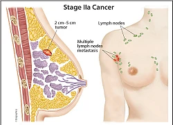Ung thư vú giai đoạn 2: Đặc điểm và dấu hiệu của bệnh