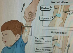 Kéo giật tay trẻ đột ngột dễ làm trật khớp khuỷu