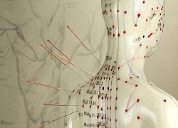 Hàng chục chiếc kim châm cứu 30 năm &#039;chạy&#039; trong cơ thể cụ bà