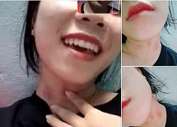 Thanh niên yêu xa video call với bạn gái phát hiện vết lạ trên cổ, nhờ dân mạng soi là cạo gió hay hickey?