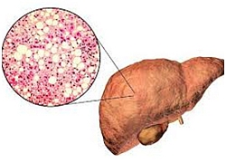 Cả chục triệu người Việt bị gan nhiễm mỡ vì thường xuyên ăn uống kiểu này