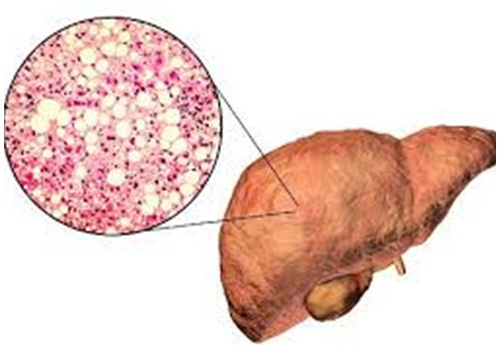 Cả chục triệu người Việt bị gan nhiễm mỡ vì thường xuyên ăn uống kiểu này