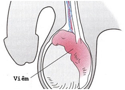 Viêm mào tinh hoàn - bệnh lý liên quan đến vô sinh ở nam giới