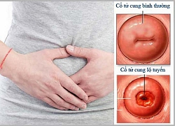 Những câu hỏi liên quan đến bệnh viêm lộ tuyến cổ tử cung