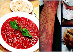 Cảnh báo tình trạng lây nhiễm liên cầu lợn