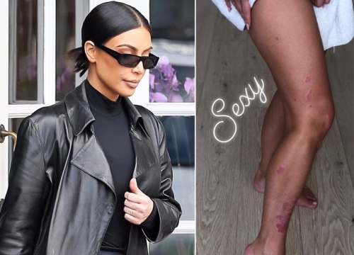 Kim Kardashian mặt loang lổ vì bệnh vẩy nến