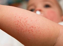 Người Mỹ đi tiêm phòng trở lại sau trào lưu "tẩy chay vaccine"