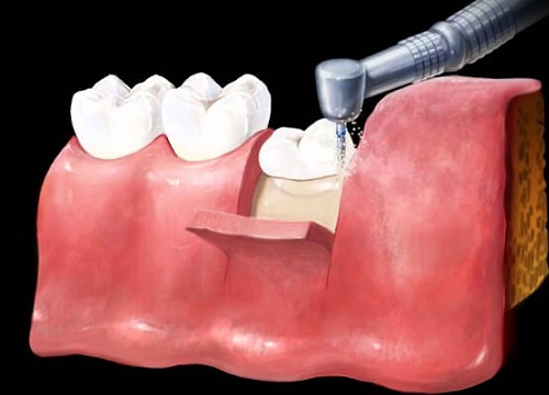 Răng khôn, vì sao phải nhổ bỏ?