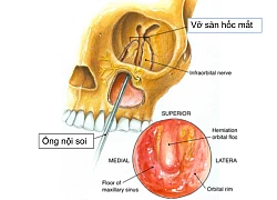 Lần đầu Việt Nam nội soi tái tạo sàn hốc mắt qua đường miệng