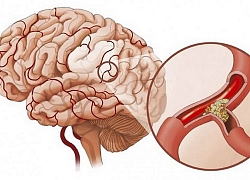 Dấu hiệu nhận biết bệnh tai biến mạch máu não