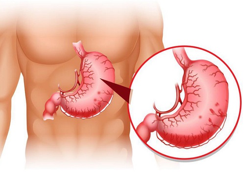 Chàng trai trẻ bị ăn mòn dạ dày vì quên một việc cực quan trọng khi uống thuốc