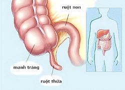 Mảnh xương cá lộ ra trong khi mổ ruột thừa