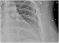 Uống 10 cốc cà phê mỗi ngày trong 7 năm, cô gái 30 tuổi có xương như cụ già