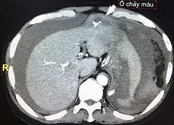 Đau bụng dữ dội sau ngã, phát hiện u gan bị vỡ